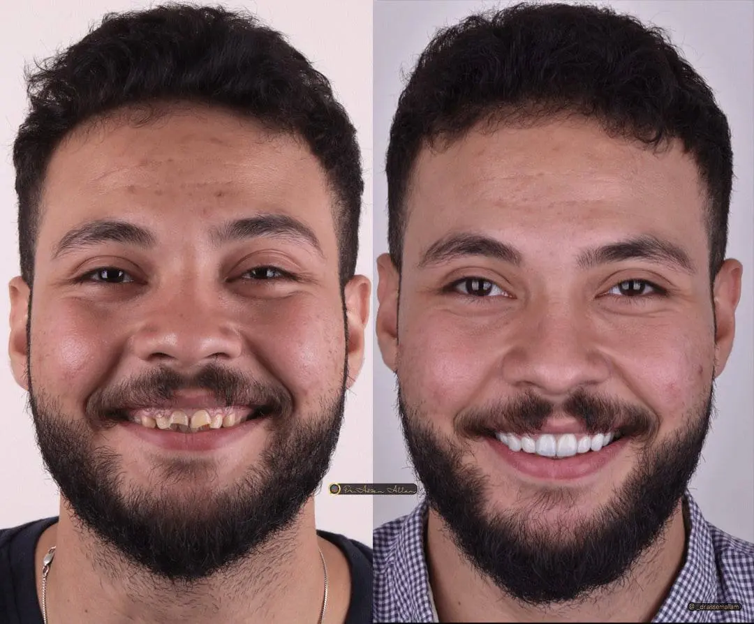 Mohamed J Before and After